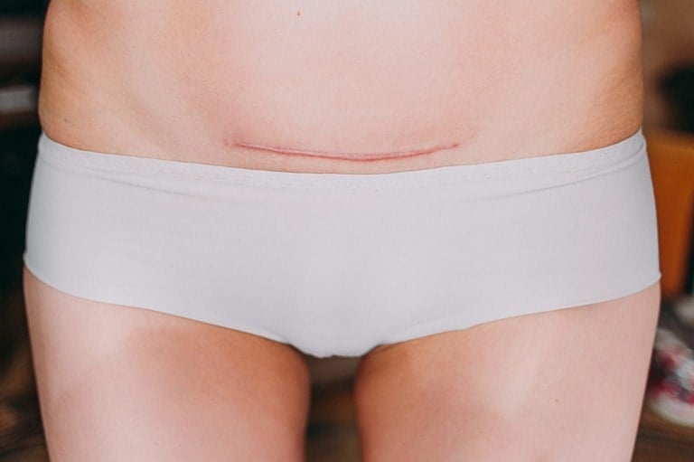 Close-up of a person wearing white underwear, revealing a horizontal scar on their lower abdomen. The scar appears to be a recent surgical incision, possibly from a Cesarean section. This image depicts part of the week-by-week c-section recovery process. The background is blurred.