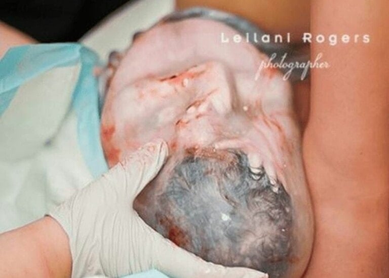 A newborn baby is seen partially covered in amniotic sac during an en caul birth, with a gloved hand assisting. The baby’s head, covered in blood and fluids, is being gently held. The background includes blue medical fabric and a woman's leg.