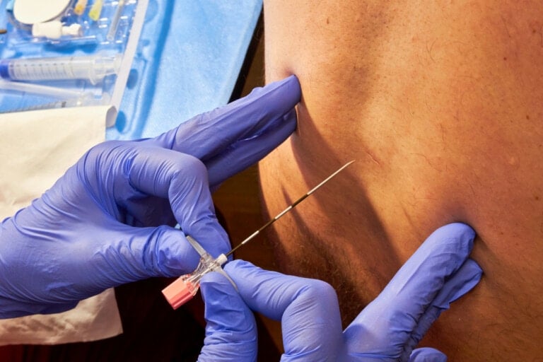 A person receiving an epidural injection in their back. The healthcare professional administering the injection is wearing blue gloves. Medical supplies and equipment are visible on a blue disposable sheet in the background, debunking common epidural myths with proper medical practice.
