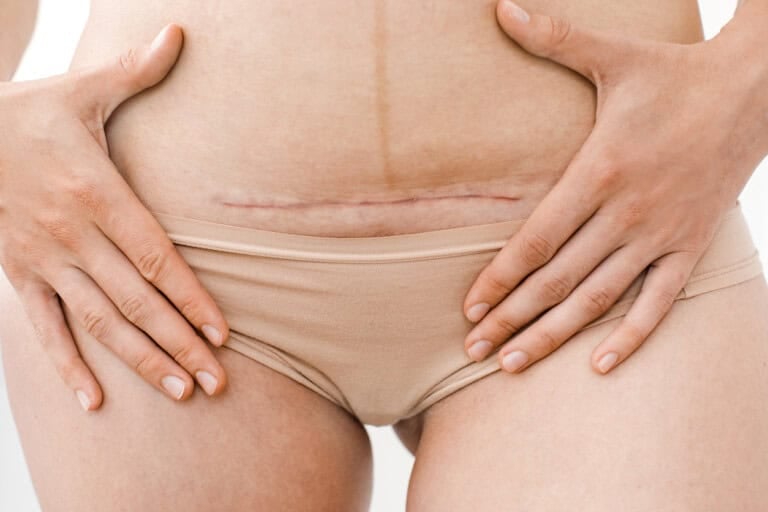 A close-up of a woman's lower abdomen showing a healed horizontal C-section scar, likely from a surgical procedure such as a C-section, with hands resting on either side and wearing beige underwear.