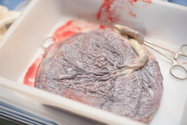 A close-up image of a placenta in a white tray, with a portion of the umbilical cord still attached. Blood and bodily fluids are visible in the tray. Surgical clamps are attached to the umbilical cord, posing questions on what to do with your placenta. The background is slightly blurred.
