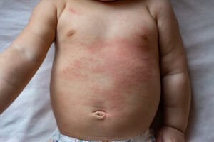 The image depicts the torso of a baby with red, patchy heat rash symptoms on the chest and stomach area. The babys arm is extended against a soft, light-colored fabric.