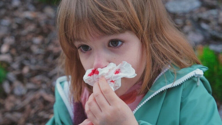A young girl with a bloody nose holds a tissue to her face. She is wearing a green jacket and appears to be outdoors. The background is slightly blurred with soil and greenery visible, illustrating the common occurrence of nosebleeds in kids during playtime.