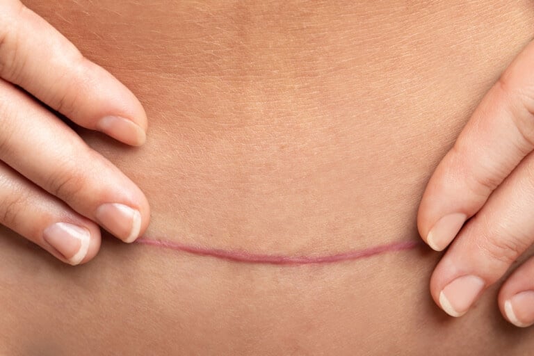 Close-up of two hands gently pulling the skin around a thin, slightly raised C-section scar on a person's body. The linear scar appears healed, with its light pink color indicating recent scar tissue formation.